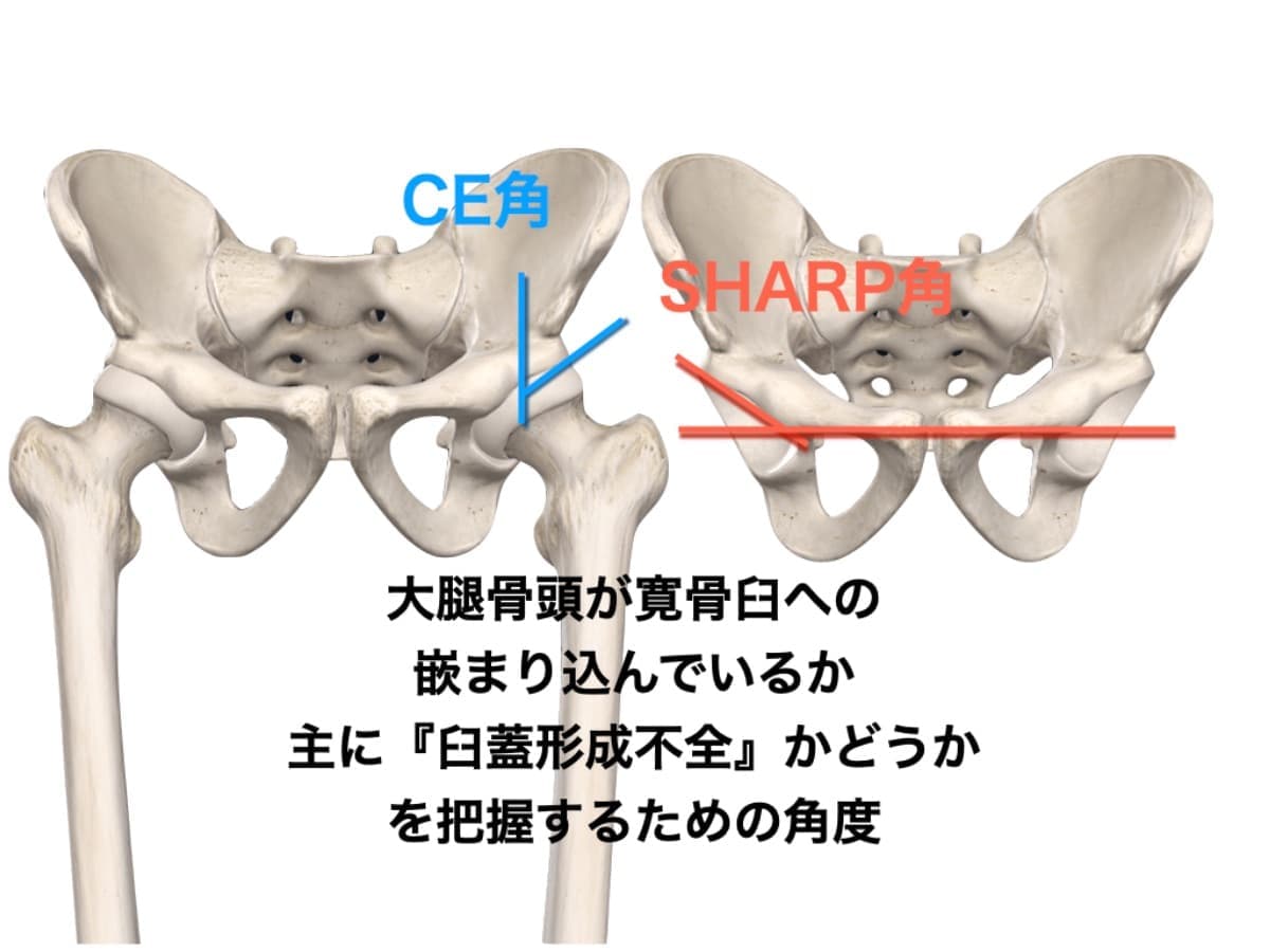 臼蓋形成不全と仙腸関節