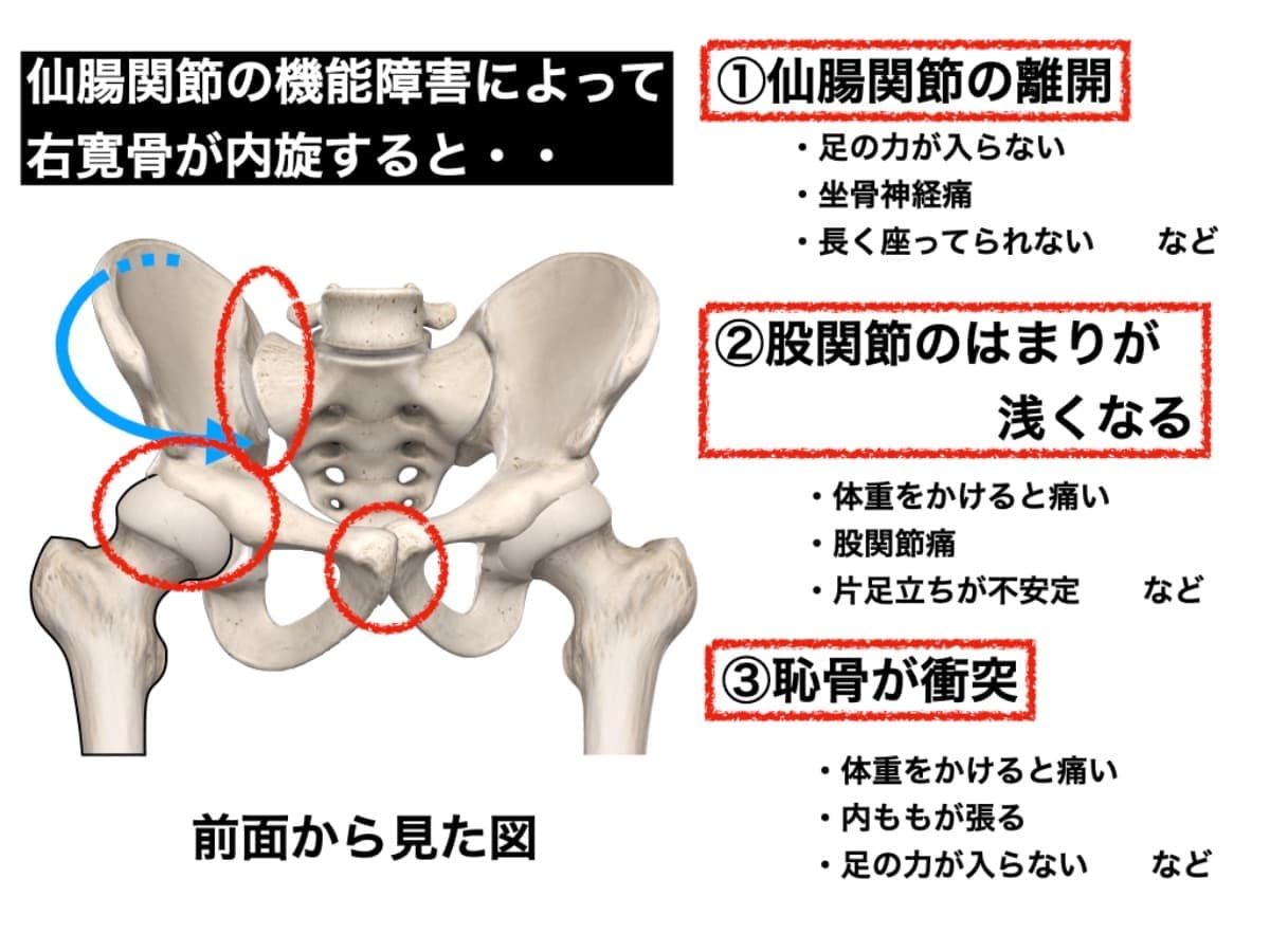 仙腸関節の障害と様々な症状