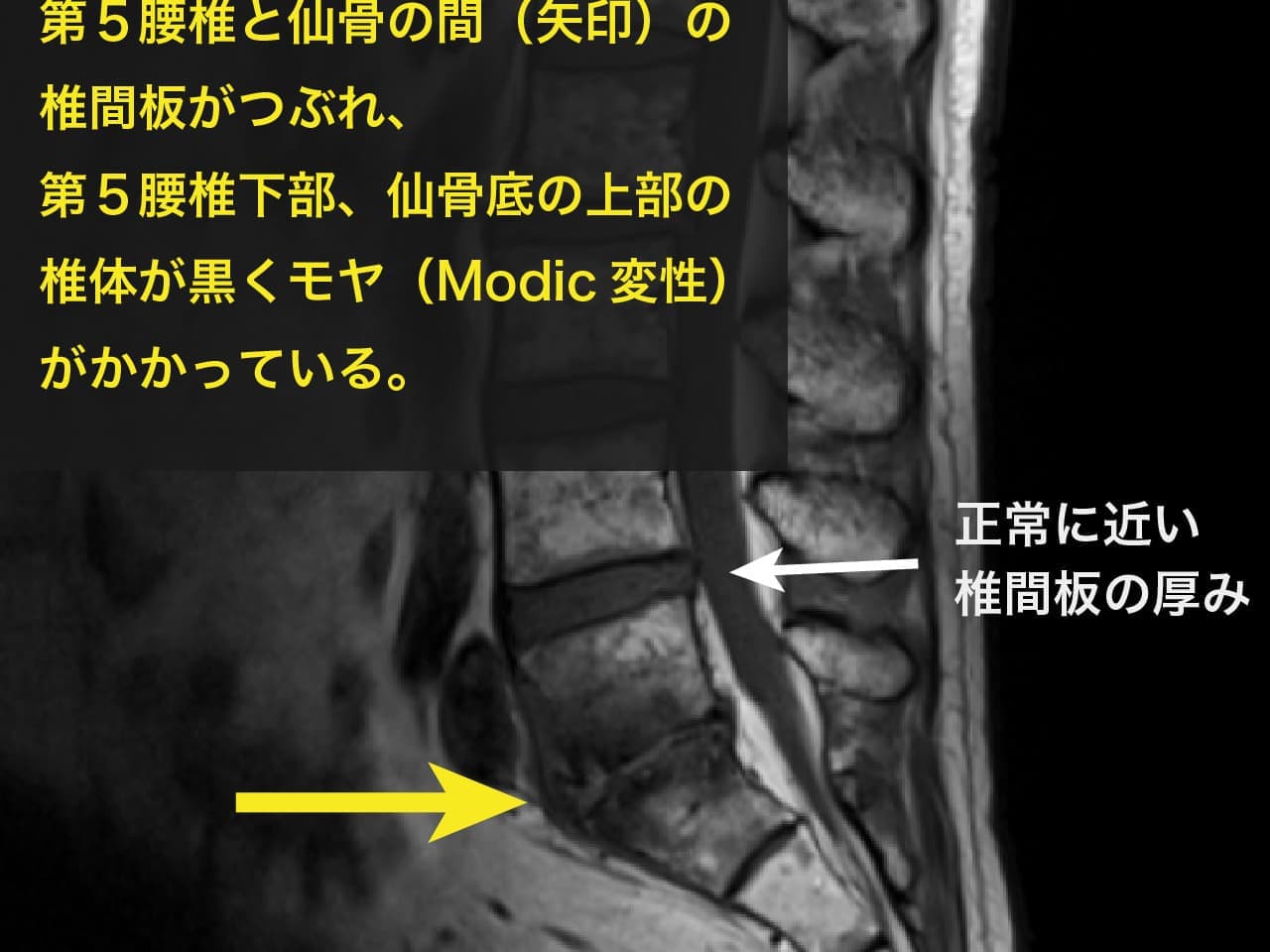 仙腸関節と坐骨神経の関連