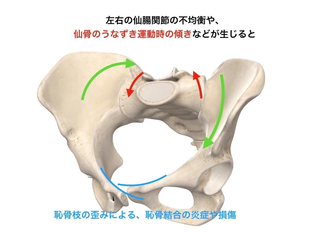 臼蓋形成不全と仙腸関節