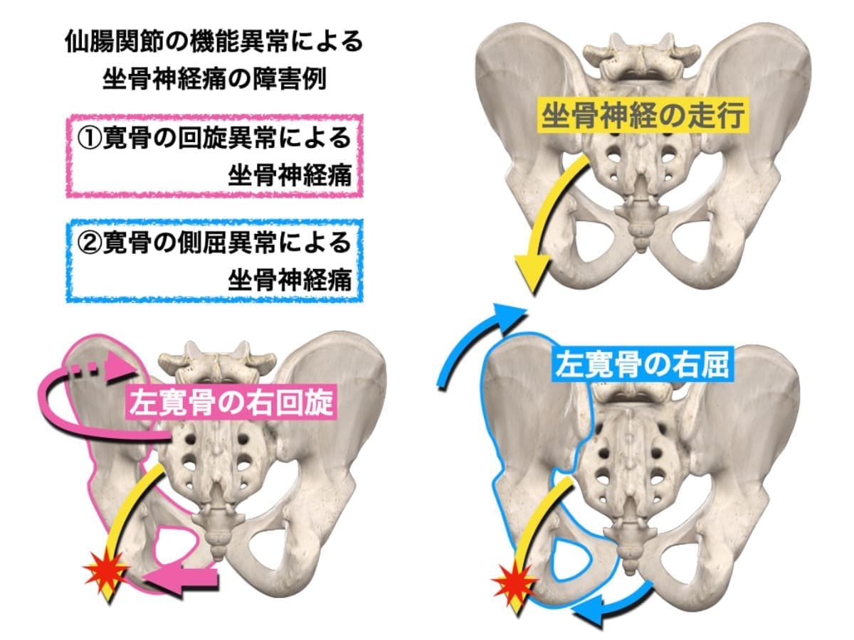 仙腸関節と坐骨神経の関連
