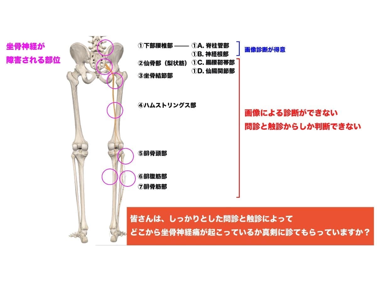 坐骨神経の障害ポイント