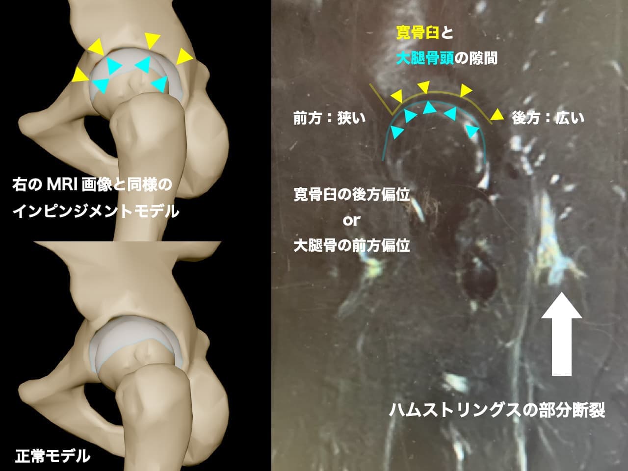 仙腸関節とFAI
